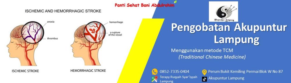 AKUPUNTUR LAMPUNG – 0852.7335.0404